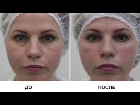 Убираем тёмные круги и мешки под глазами без операции