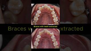 Teeth extraction when braces #orthodontist #dentist #braces Don T Worry About Tooth Extraction With Braces Ardaarisan