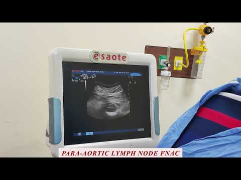 Video: Hvor er para-aorta-lymfeknuden placeret?