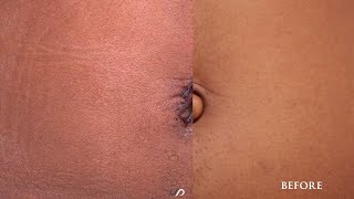 Umbilicolplasty | Female Body Contouring | Dr. David Stoker Umbilicolplasty | Female Body Contouring | Dr. David Stoker