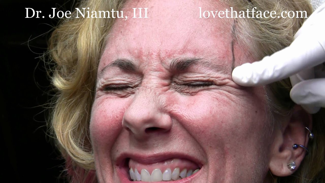 Joe Botox Botox Browlift by Dr. Joe Niamtu, III - YouTube