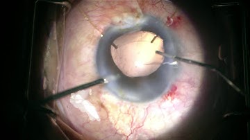 Iatrogenic Zonular Dialysis