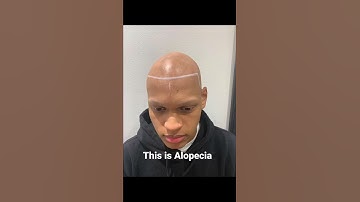 Cure Alopecia with SMP (scalp-micropigmentation)