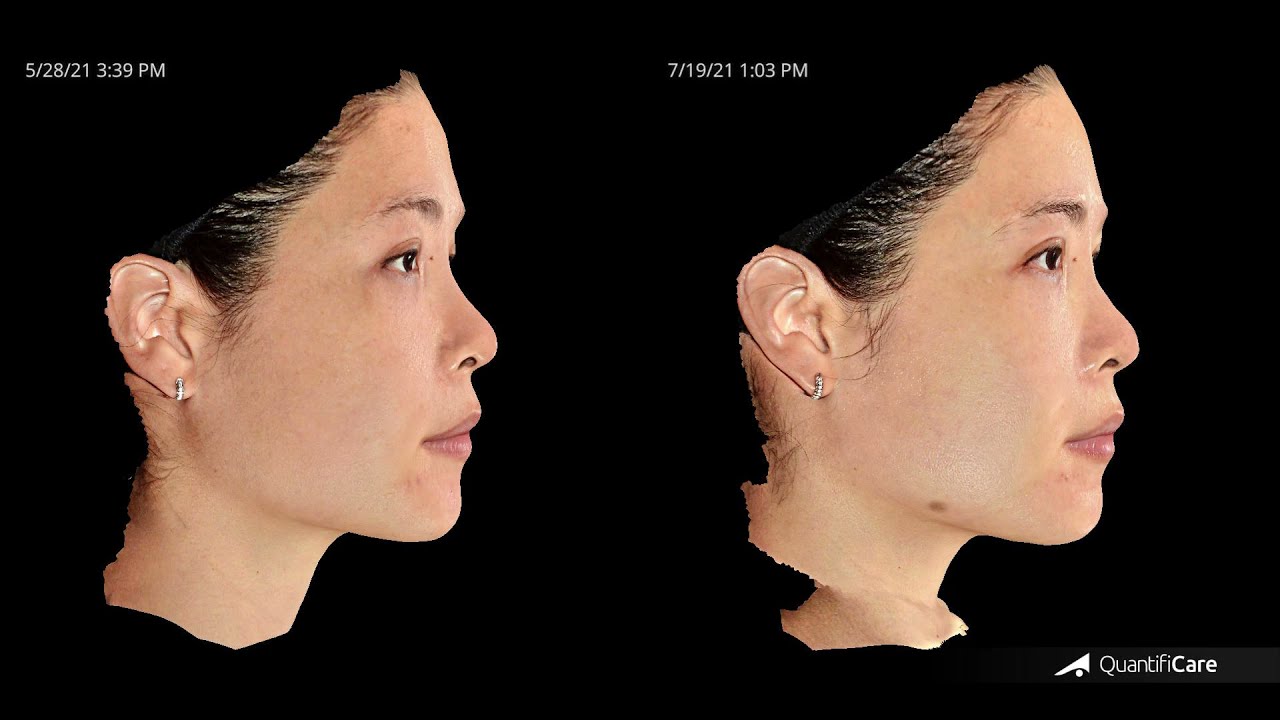 Ultherapy Malaysia | 本地艺人Emily Lim 亲身经历 | Clique Clinic