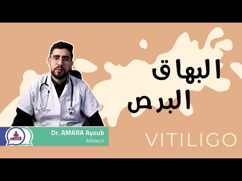  البهاق والبرص