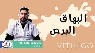 VITILIGO  البهاق والبرص