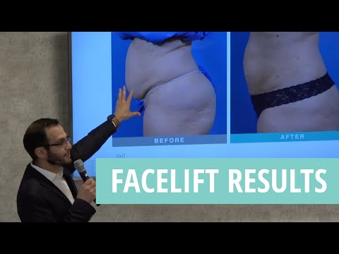 Newport Beach, CA | Dr. Hakimi's FaceLift Results | Hakimi Plastic Surgery