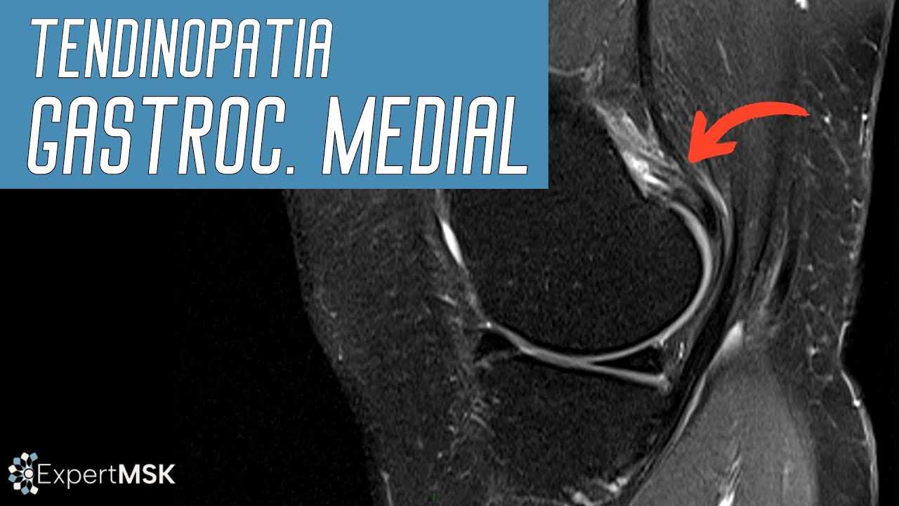 Tendinopatia Proximal do Gastrocnêmio Medial  (é raro, mas acontece muito)!