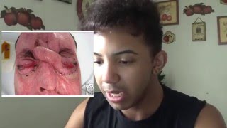 Why Does My Butthole Bleed?
