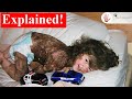 3 People With Skin Conditions That Evolved to a Never-Seen-Before Level!! ~ Body Bizarre!