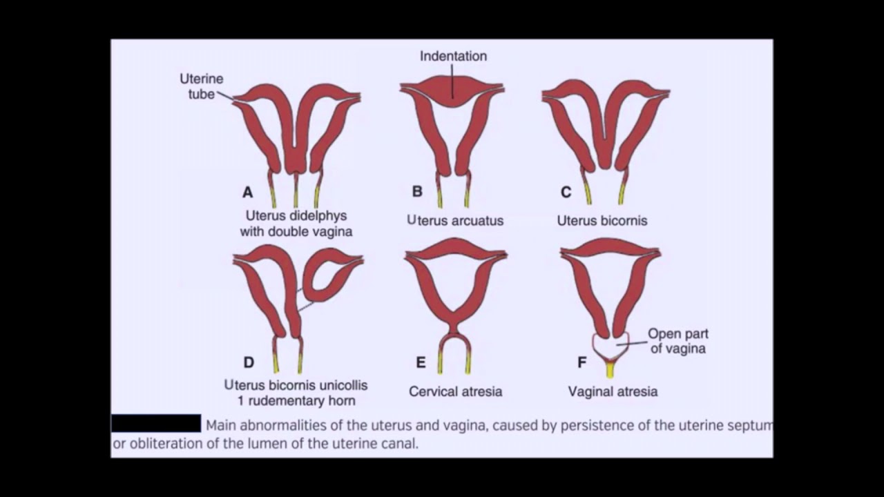 Robotic Uterus Didelphys Didelphis Ca Endometrium And Icg Slnb Youtube