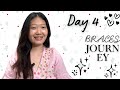 Day 4 | Braces Journey Experience 😬| Akku Nisso