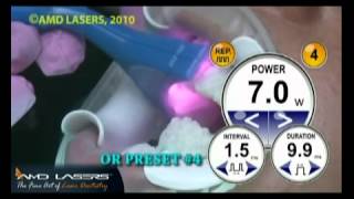 Laser Teeth Whitening With Pico