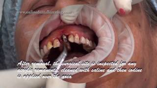 Maxillary Central Incisor Replacement with Implant