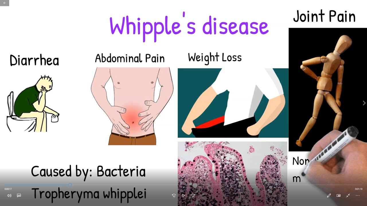 Whipple's disease made easy. Whipple disease symptoms, treatment