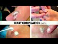 WART BURNING COMPILATION (Part 1/4) | Dr. Paul