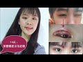 割雙眼皮分享 | Double Eyelid Surgery