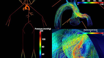 Numerical simulation of LVAD implant at 8000 RPM in a patient with moderate heart failure