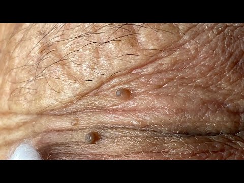 Video Huong Da Nang Acne Treatment #286 - Ms. Hoa Part 2 - youtube