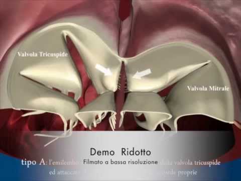 Difetti canale intraverticolare