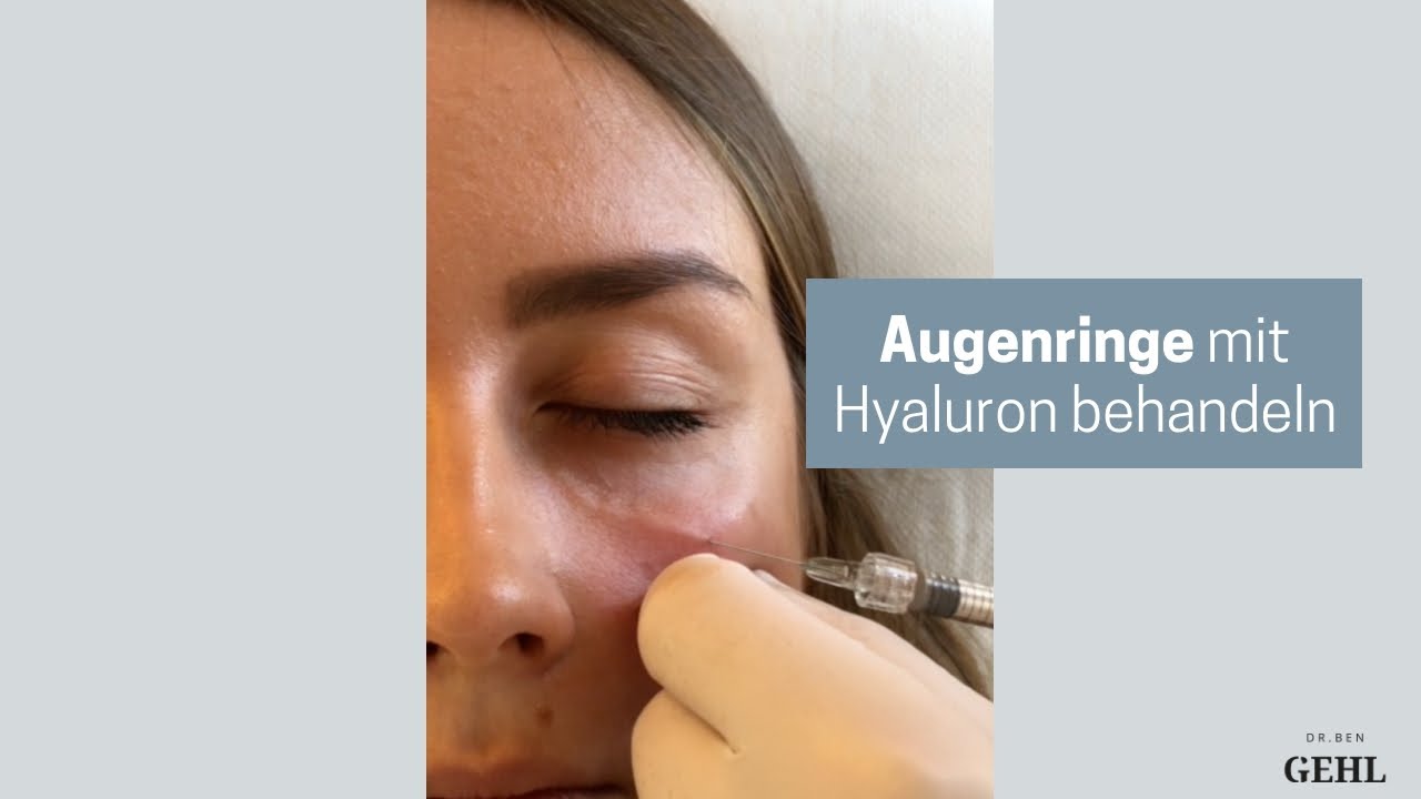 Augenringe Unterspritzen Mit Filler Dr Ben Gehl Wien Youtube