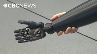 Gaza amputees get 3D printed limbs from the Victoria Hand Project