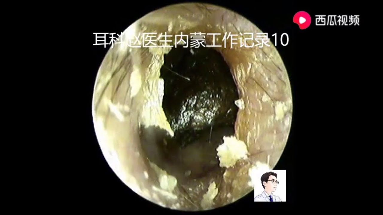 Cerumen lumps and debris, 7 minutes耵聍硬块和耵聍碎片,7分钟 - YouTube