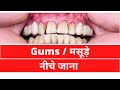 मसूड़े खून आना, सूजन,नीचे जाना  || Gums Recession, Problem, Swelling, Pain, going down | Home Remedy