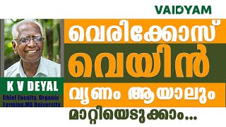 വെരിക്കോസ് വെയിൻ- വൃണം ആയാലും മാറ്റിയെടുക്കാം ...NaturalAyurvedic Treatment, Varicose Veins |kvdayal