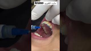ما هو مثبت التقويم ؟! What are Retainers after Braces?? #braces #orthodontist #retainer #تقويم screenshot 3