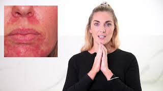 How To Treat Skin Redness | Rosacea - it's Causes and Treatments