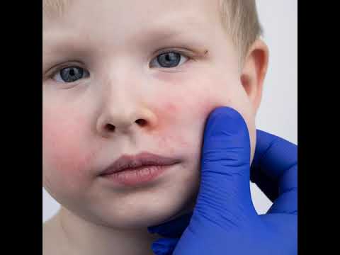 Pediatric Eczema and