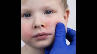 Pediatric Eczema and Scratch Sensors with Steve Xu, MD, MSc