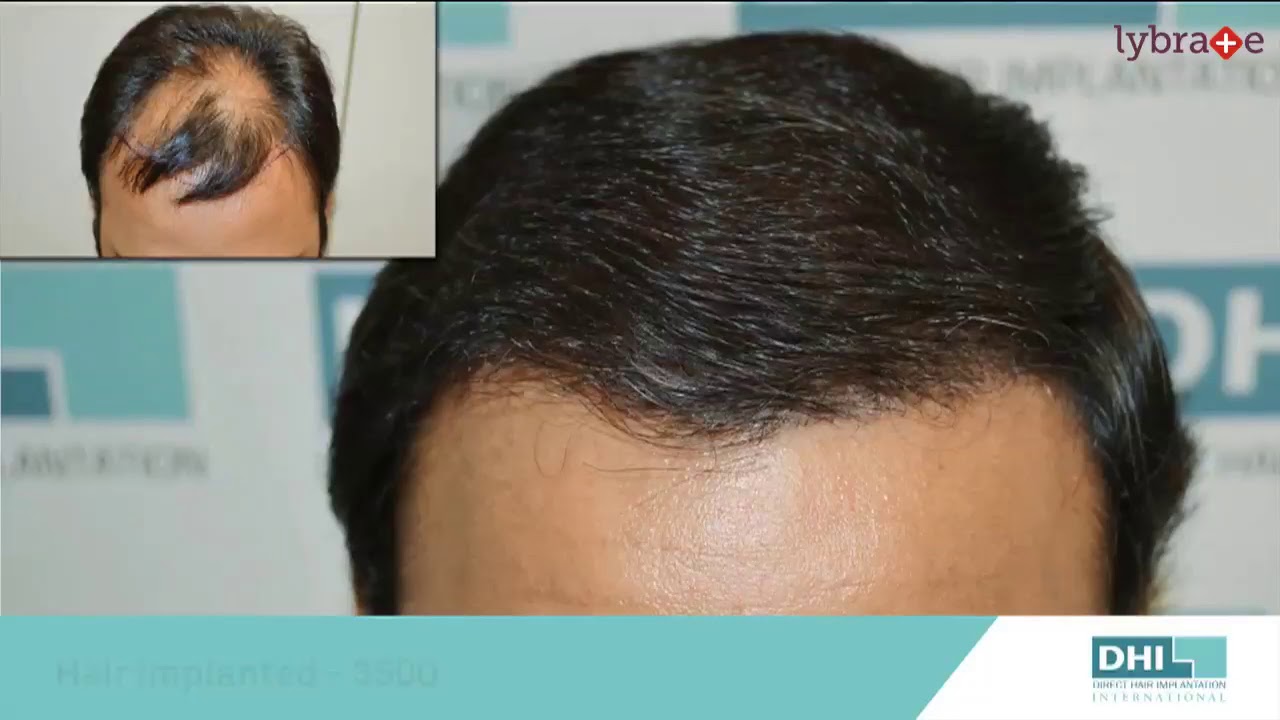 Best Hair Fall Treatment for Men Effective Hair Loss Treatment