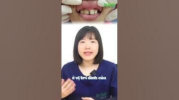 Phanh môi bám thấp | Dr Anh Thư