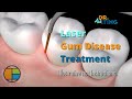 Laser Periodontal Therapy | Ask Dr. Ting