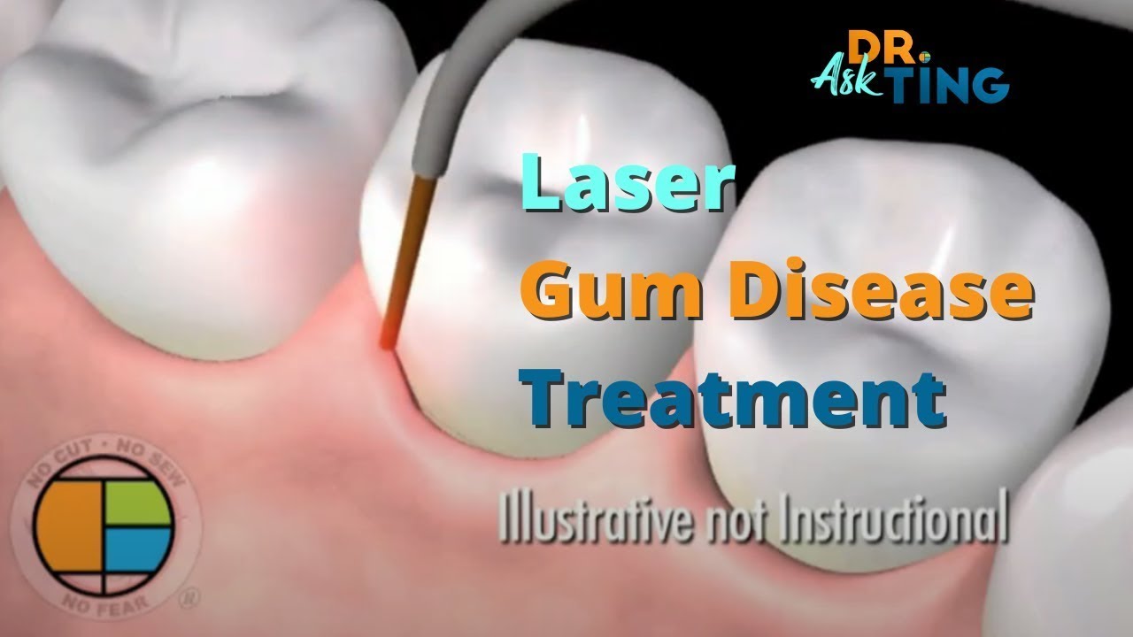 Laser Periodontal Therapy Ask Dr. Ting YouTube