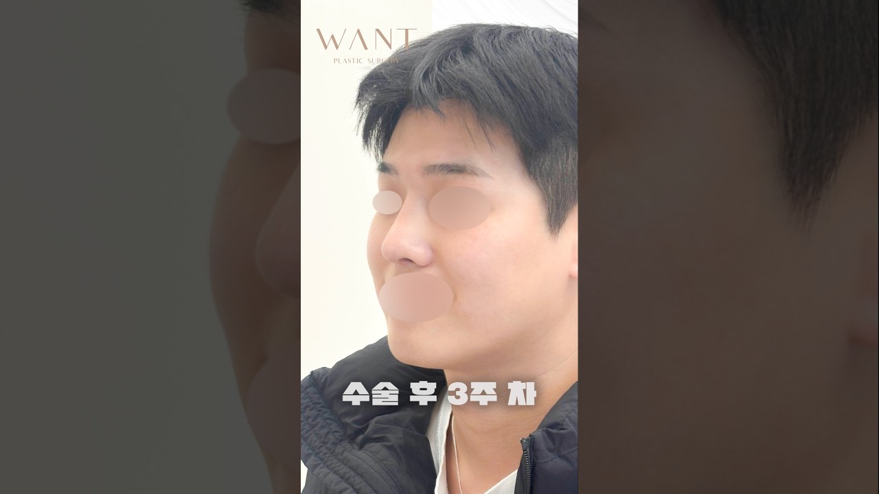 [Вонт гоо сайхны мэс засал] Хамар хугарсан мэс заслын дараа хамар дахин засуулах + өөрийн хавирганы мөгөөрс + хамрын тулгуур хэсгийн сорвийг сайжруулах + хамрын тулгуурыг доошлуулах. Эрэгтэй хүнийг хамар чимдэг байх нь ээ...😍👍 #shorts #selfie #хамарзасал #рилс