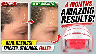 4 MONTH RESULTS | CURRENTBODY LED HAIR GROWTH HELMET