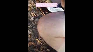 Cyst Pop on Thigh oddlysatisfying sick blackhead pimplepopper satisfying cyst omg wow