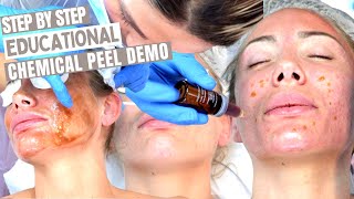 12 Step Chemical Skin Peel | Step By Step Procedure Performance Tutorial | Level 4 VTCT Accredited