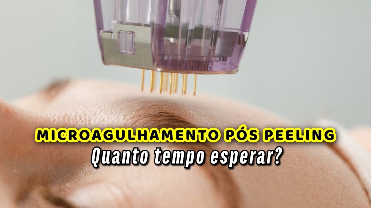 Quanto tempo após PEELING posso fazer o MICROAGULHAMENTO? - YouTube