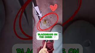 Did you make it to the end? 😊🤍 #shorts #short #blackheads #reaction #oddlysatisfying #pimple #asmr