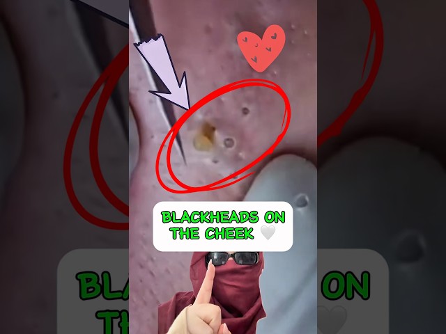 Did you make it to the end? 😊🤍 #shorts #short #blackheads #reaction #oddlysatisfying #pimple #asmr