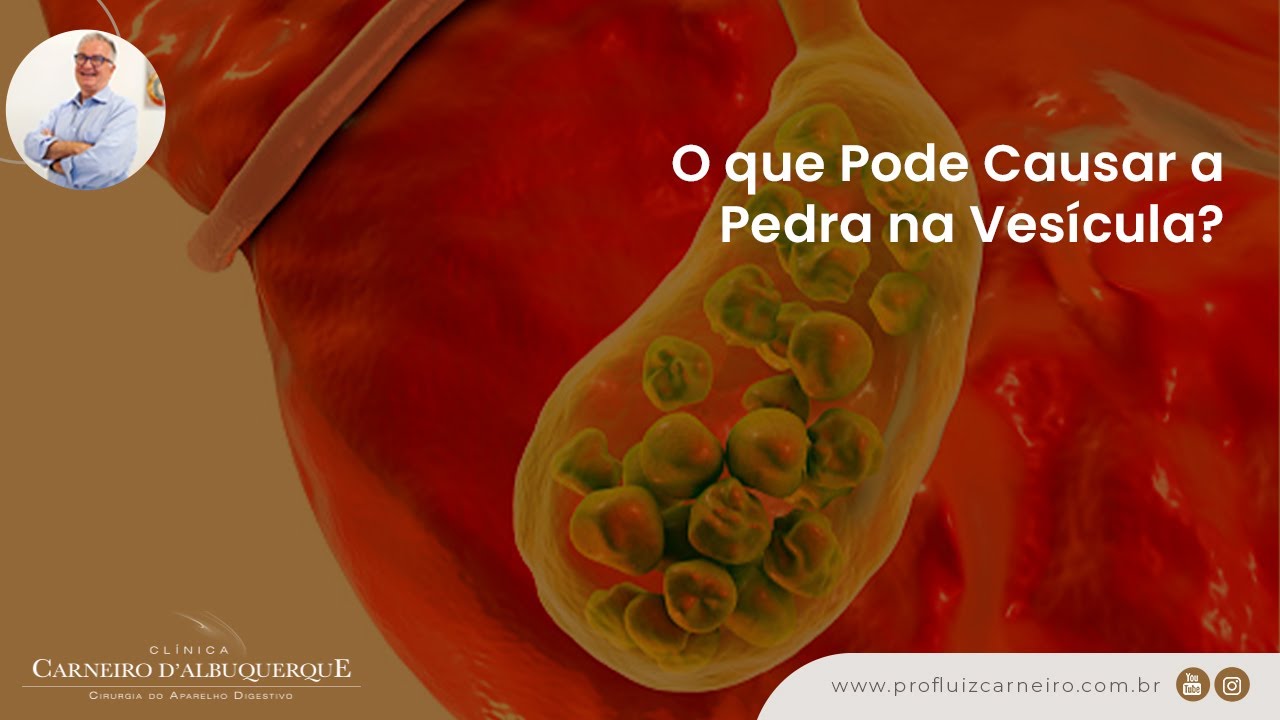 O que Causa Pedra na Vesícula? | Prof. Dr. Luiz Carneiro CRM 22761 ...