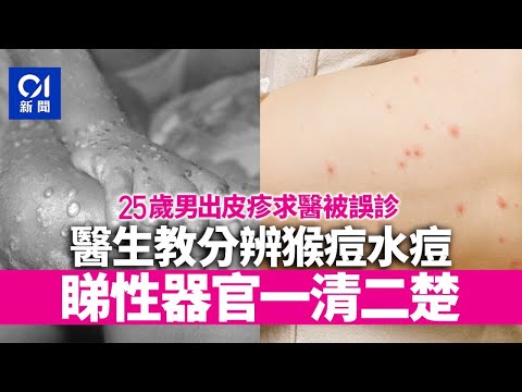 猴痘｜確診者求醫誤診水痘 兩者怎樣分？ 醫生：猴痘集中一部位｜01新聞｜傳染病｜感染｜病徵｜水痘｜疫情