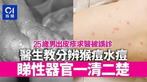 猴痘｜确诊者求医误诊水痘　两者怎样分？　医生：猴痘集中一部位｜01新闻｜传染病｜感染｜病征｜水痘｜疫情 - 天天要闻