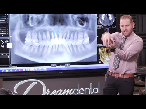 how-do-i-best-protect-my-dental-implant-while-it's-healing?