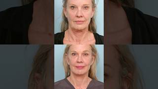 She Got a Deep Plane Facelift at 65 – See How Natural She Looks #Facelift