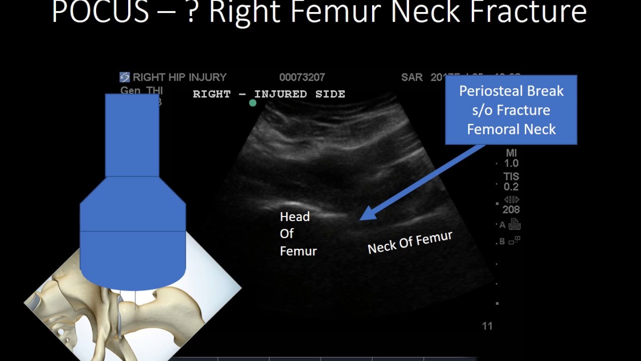 intertrochanteric fracture youtube intertrochanteric fracture